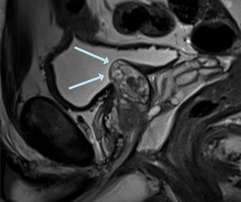 Laser Focal Therapy for BPH | Prostate Laser Center