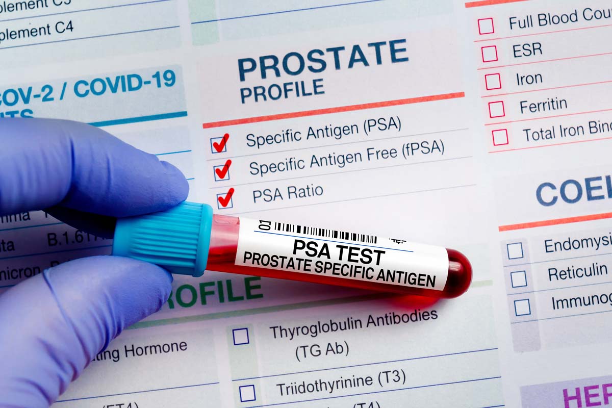 A gloved hand holds a vial labeled 'PSA Test.'