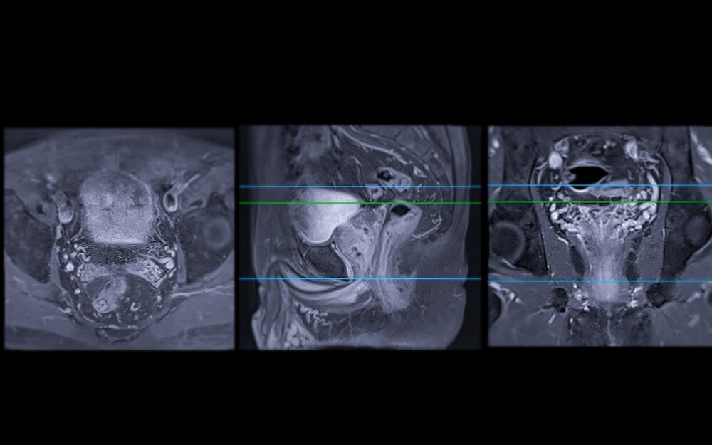 Three MRI images of the prostate gland. 