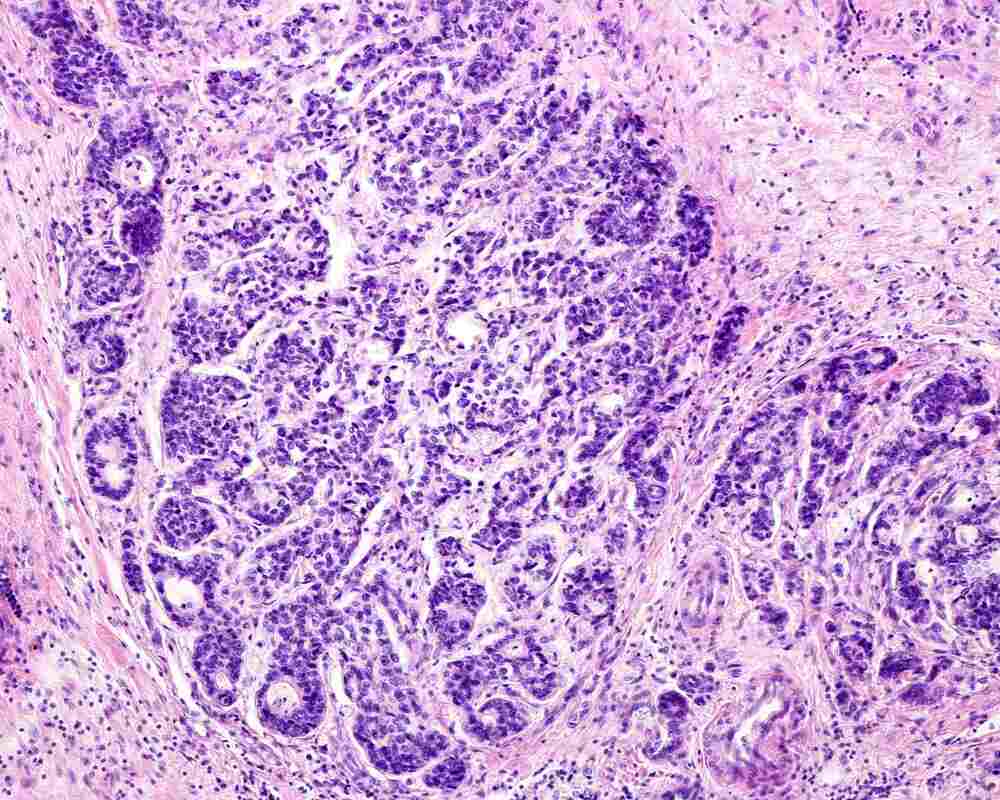 An example of cancerous cells in the prostate. 